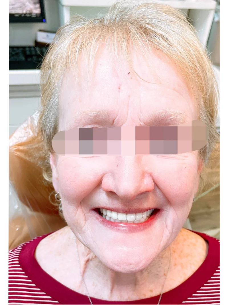 After treatment: Teeth Restoration patient at Premier Dental