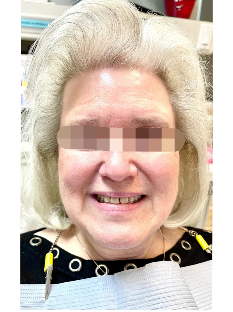Before treatment: Smile Transformation patient at Premier Dental