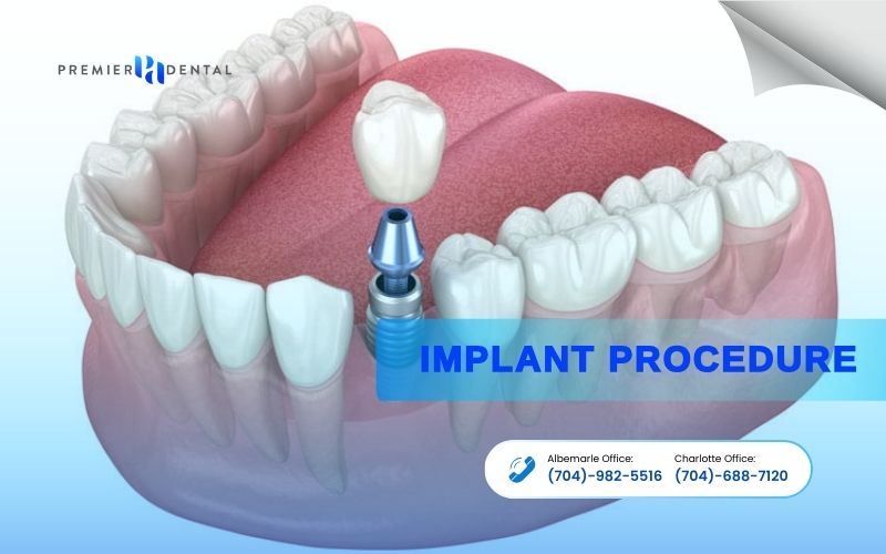 Implant DentistryImplant Procedure