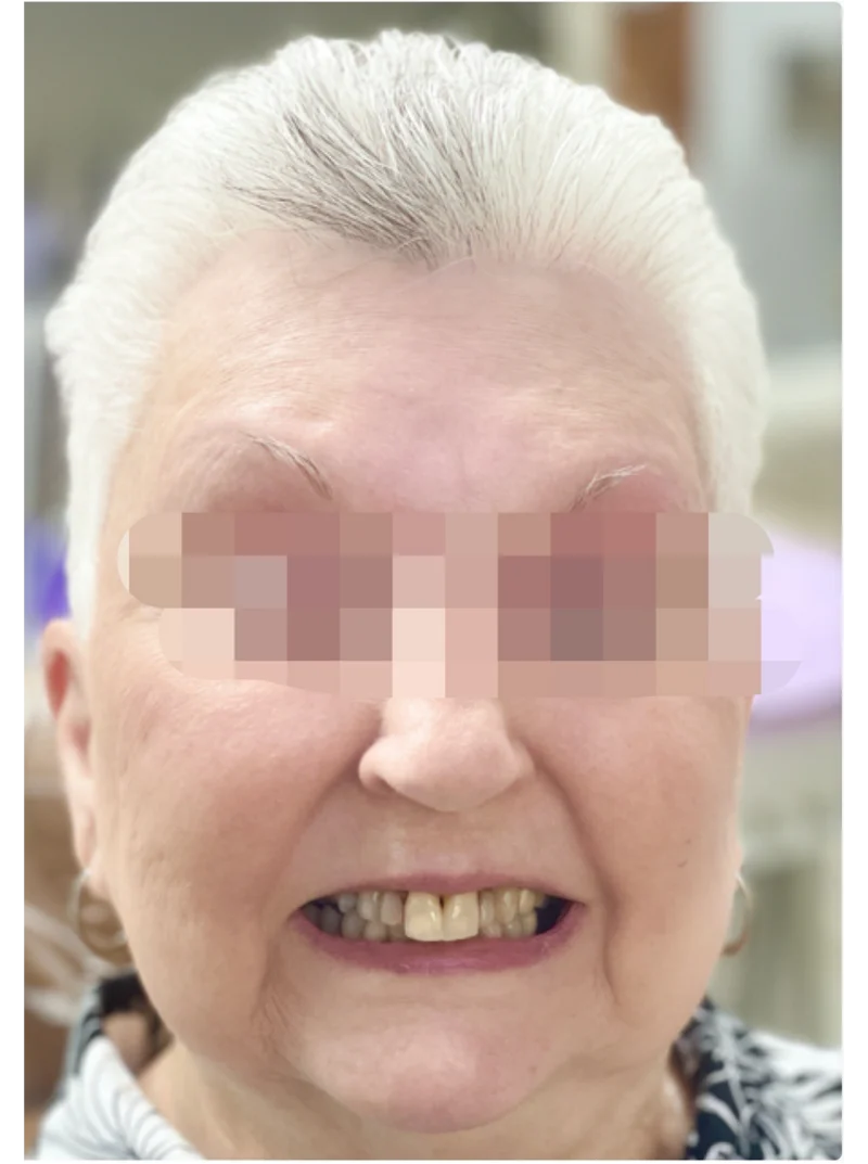 Before treatment: Smile Makeover patient at Premier Dental