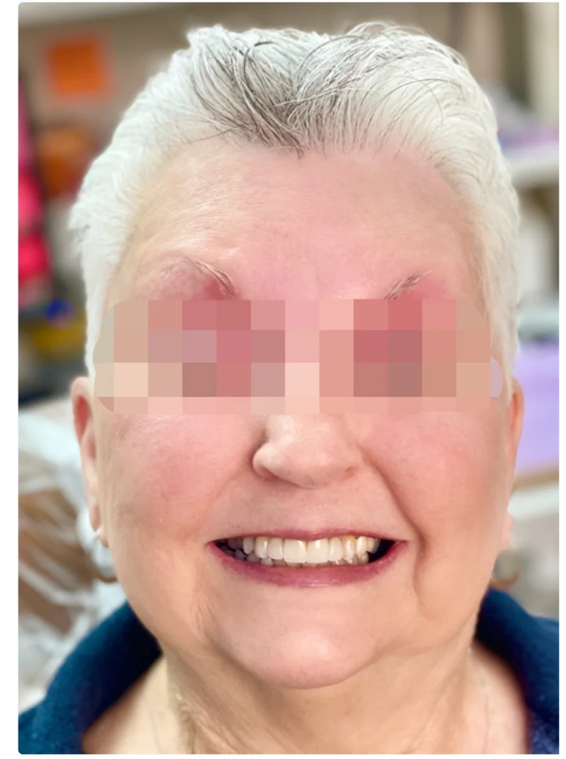 After treatment: Smile Makeover patient at Premier Dental