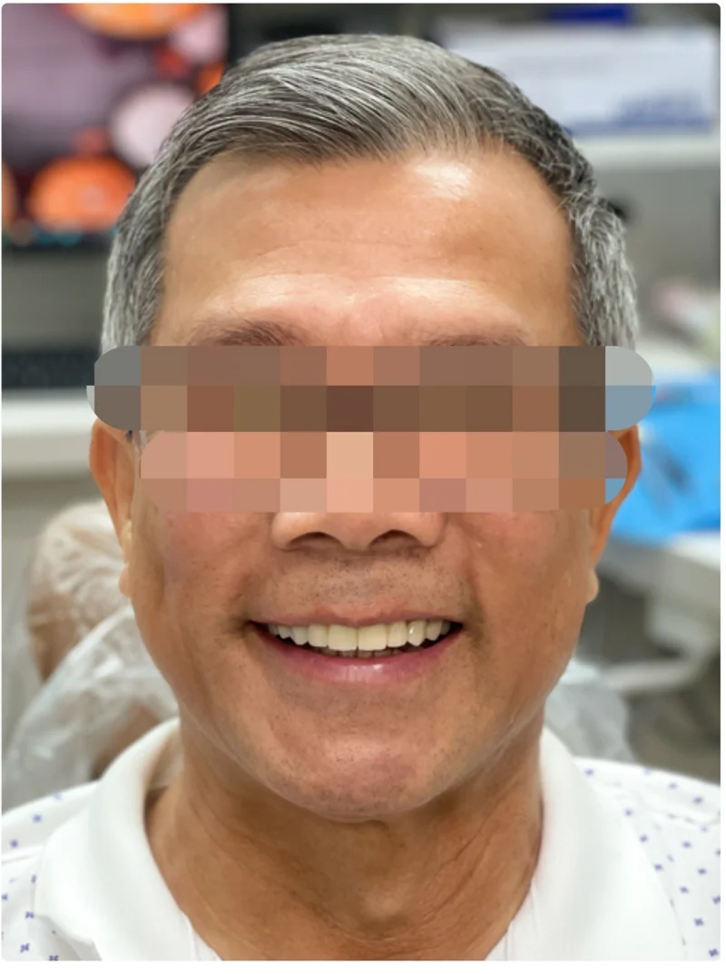 After treatment: Crowns & Veneers patient at Premier Dental