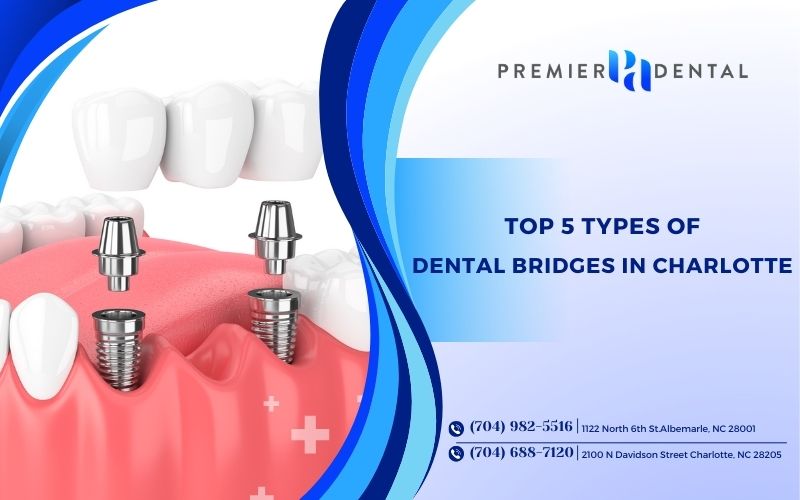 Top 5 Types of Dental Bridges in Charlotte, NC