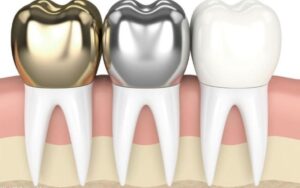 dental crowns in charlotteWhen Are Crowns Needed?
