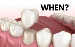 dental crowns in charlotteDental Crown in Charlotte Procedure Steps