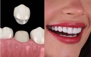 dental crowns in charlotteDental Crown Aftercare