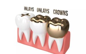 dental crowns in charlotteVeneer