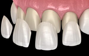 dental crowns in charlotteDental Implants