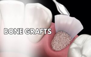 dental implants in charlotteLongevity of Implants