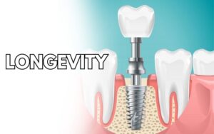 dental implants in charlotteHealing Process after Implants