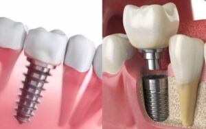 dental implants in charlotteImmediate-Loading Implants