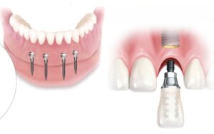 dental implants in charlotte3 Steps in Dental Implant Procedure