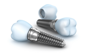 Implant Materials in CharlotteTitanium Implants