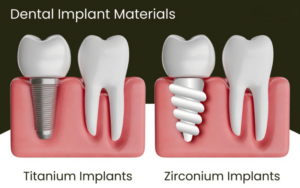 Implant Materials in CharlotteComparing Titanium vs. Zirconia Implants