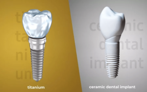 Implant Materials in CharlotteComparing Titanium vs. Ceramic Implants