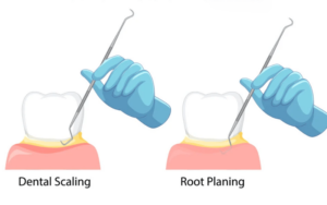 Restorative Procedures for Gum HealthScaling and Root Planing