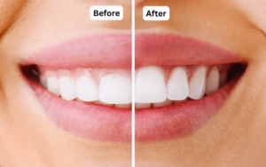 Restorative Procedures for Gum HealthLaser Gum Surgery