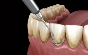 Restorative Procedures for Gum HealthRisks Associated with Restorative Procedures for Gum Procedures