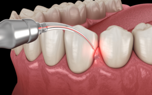Restorative Procedures for Gum HealthAlternatives to Restorative Procedures for Gum Health in Charlotte