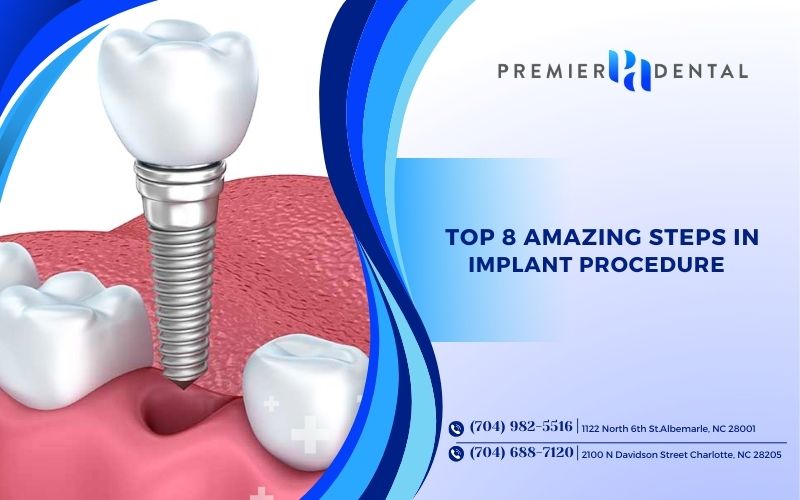 Top 8 Amazing Steps in Implant Procedure in Charlotte, NC