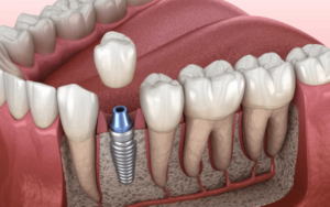 Types of Dental Implants in CharlotteSingle Tooth Implants: A Top Choice in Charlotte