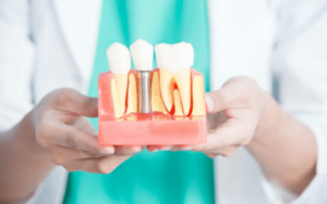 Types of Dental Implants in CharlotteThe Benefits of Single Tooth Implants