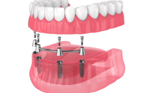 Types of Dental Implants in CharlotteFull-Mouth Implants in Charlotte, NC