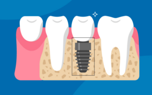 Types of Dental Implants in CharlotteThe Benefits of Endosteal Implants