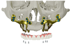 Types of Dental Implants in CharlotteSubperiosteal Implants in Charlotte, NC
