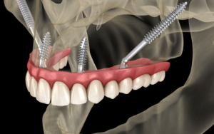 Types of Dental Implants in CharlotteZygomatic Implants in Charlotte, NC