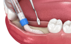 Types of Dental Implants in CharlotteImmediate Loading Implants in Charlotte, NC