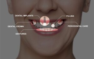 Full mouth restoration in CharlotteTimeline for Full Reconstruction