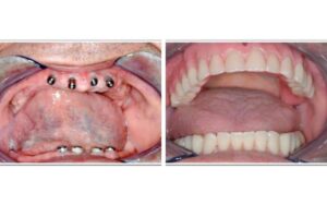 Full mouth restoration in CharlottePost-Procedure Success Stories