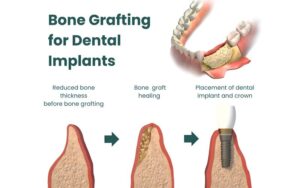 Implant Procedure in CharlotteBone Grafting for Dental Implants