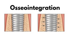 Implant Procedure in CharlotteHealing Time (Osseointegration)