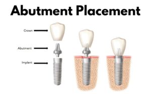 Implant Procedure in CharlotteAbutment Placement