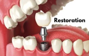 Implant Procedure in CharlotteRestoration (Crown Placement)