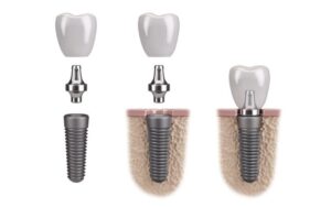 restorative dentistry materialsTitanium for Implants