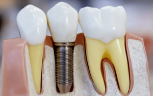 Benefits of Dental ImplantsPermanent Tooth Replacement