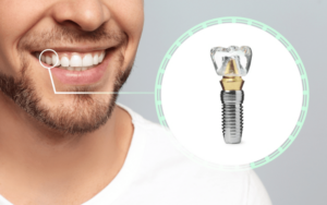 Benefits of Dental ImplantsSpeech Improvement