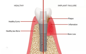 Benefits of Dental ImplantsDurability and Longevity