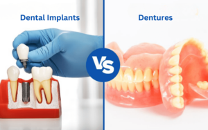 Benefits of Dental ImplantsComfort Compared to Dentures