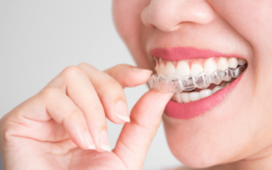 Invisalign Process in CharlotteTreatment Duration