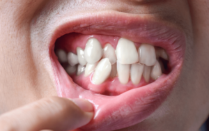 Suitability and Eligibility in CharlotteInvisalign for Crowded Teeth