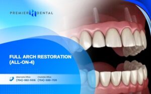 Implants for Special Cases in CharlotteFull Arch Restoration (All-on-4)