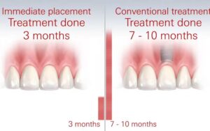Implants for Special Cases in CharlotteImmediate vs. Delayed Implants