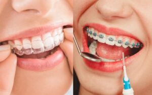 Invisalign vs. Traditional BracesAesthetic Differences
