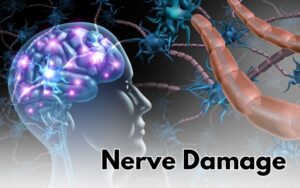 Risks and Complications in CharlotteNerve Damage