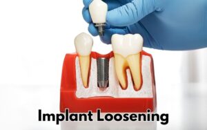 Risks and Complications in CharlotteImplant Loosening