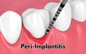 Risks and Complications in CharlottePeri-Implantitis